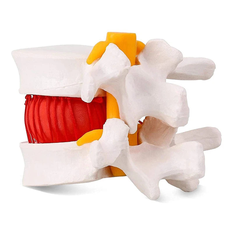 Modelo vertebral lombar do modelo de demonstração de hérnia de disco intervertebral lombar humano