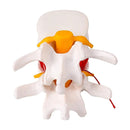 Lumbar Vertebral Model of Human Lumbar Intervertebral Disc Herniation Demonstration Model