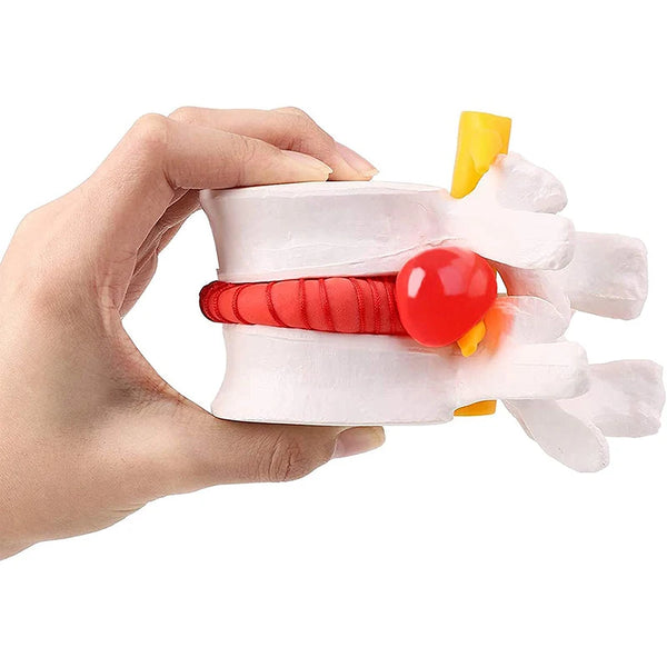 Modèle vertébral lombaire de modèle de démonstration de hernie discale intervertébrale lombaire humaine