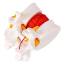 Lumbar Vertebral Model of Human Lumbar Intervertebral Disc Herniation Demonstration Model
