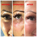 Caneta de Plasma Micro Plexr Elevador de Pálpebras Sardas Acne Marca de Pele Removedor de Manchas Escuras para Máquina de Remoção de Tatuagens Faciais Terapia de Picosegundos