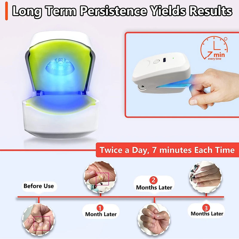 Nail Fungus Cleaning Laser Device Blue Light Nail Therapy for Damaged Discolored Thick Toenails Nail Fungus Treatments Machine