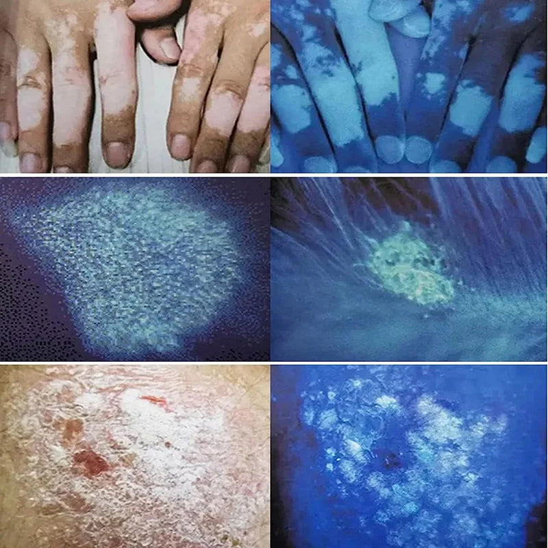 新しい皮膚アナライザー森ランプポータブル白斑検出器皮膚分析機充電式皮膚検出ウッドライトランプ