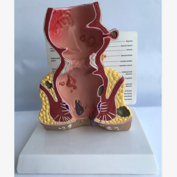 Patológiák A végbélmodell modellje Rectum Anatómiai modell