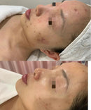 ポータブルモーフィアス 8 プロフェッショナルマシンラジオ周波数ゴールドマイクロニードルスキンリフティングと引き締めアンチエイジングにきび除去