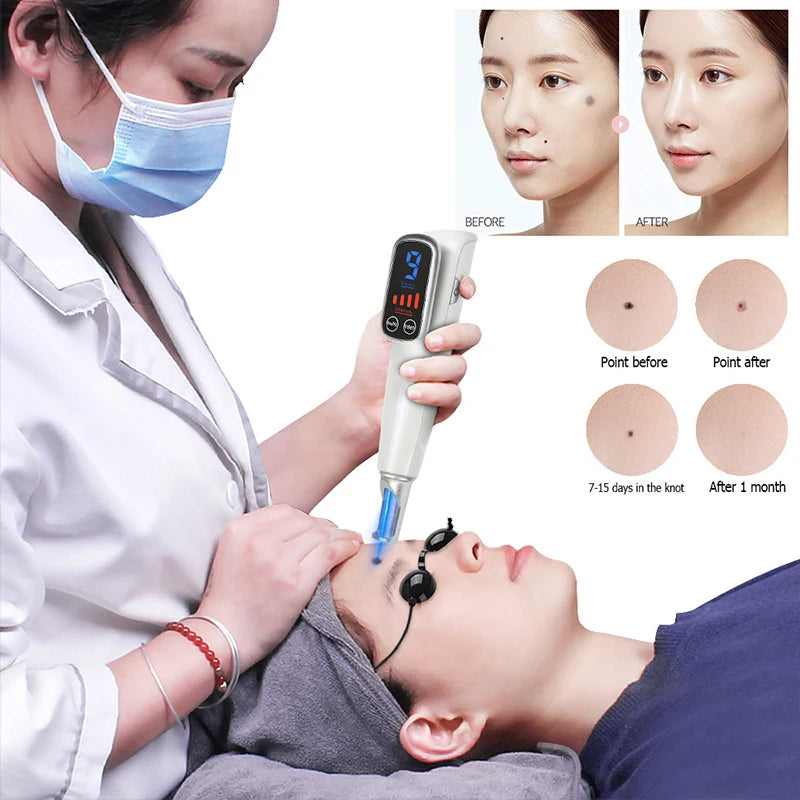 Acne Remove Machine Laser Picosecond Pen Blue Light Therapy Tattoo Remove Freckle Mole Dark ...
