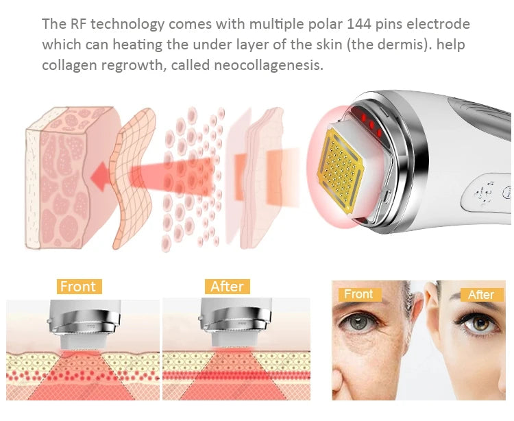 Máquina de estiramiento Facial por radiofrecuencia, matriz de puntos, eliminación de arrugas, estiramiento de la piel, dispositivo de cuidado Facial de alta frecuencia RF