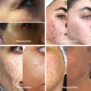 Revitalize sua pele com caneta de ozônio de plasma para tratamento de acne, rejuvenescimento da pele, redução de cicatrizes, endurecimento da pele