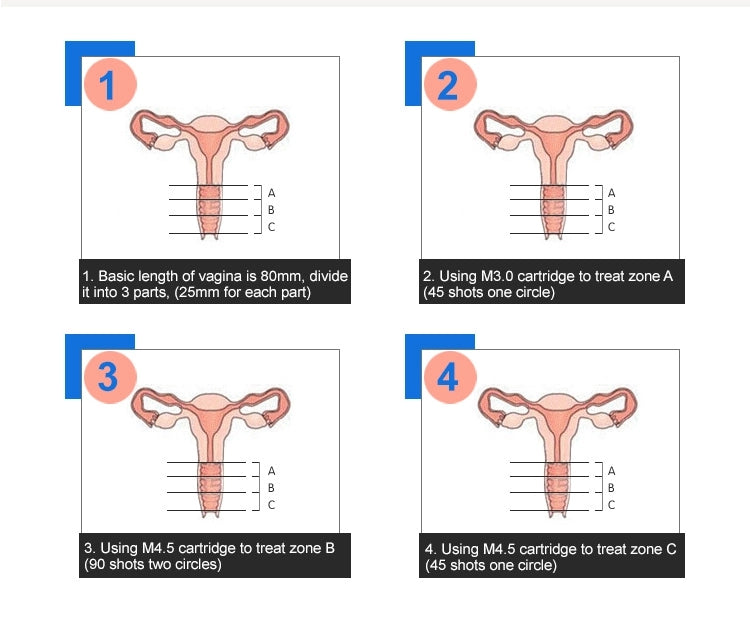 Mesin Pengetatan Vagina Hifu Portabel Mesin Perawatan Pengetatan Vagina Ultrasonik untuk pengencangan vagina Vagina Ketat