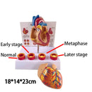 Simulering Avtagbar Anatomisk Människolivsstorlek Hjärta Kardiovaskulär anatomi Trombotisk Vaskulär medicinsk modell