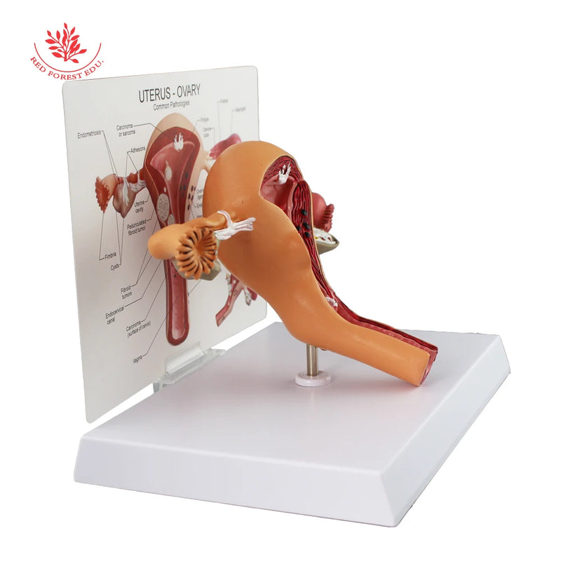 Modelo de útero, modelo de anatomia de órgãos reprodutivos femininos, patológico para educação anatômica de Forestedu