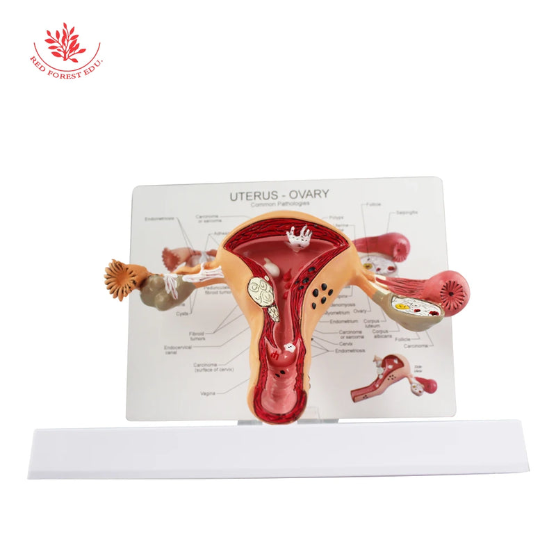 Modèle d'utérus modèle d'anatomie des organes reproducteurs féminins pathologique pour l'éducation anatomique de Forestedu