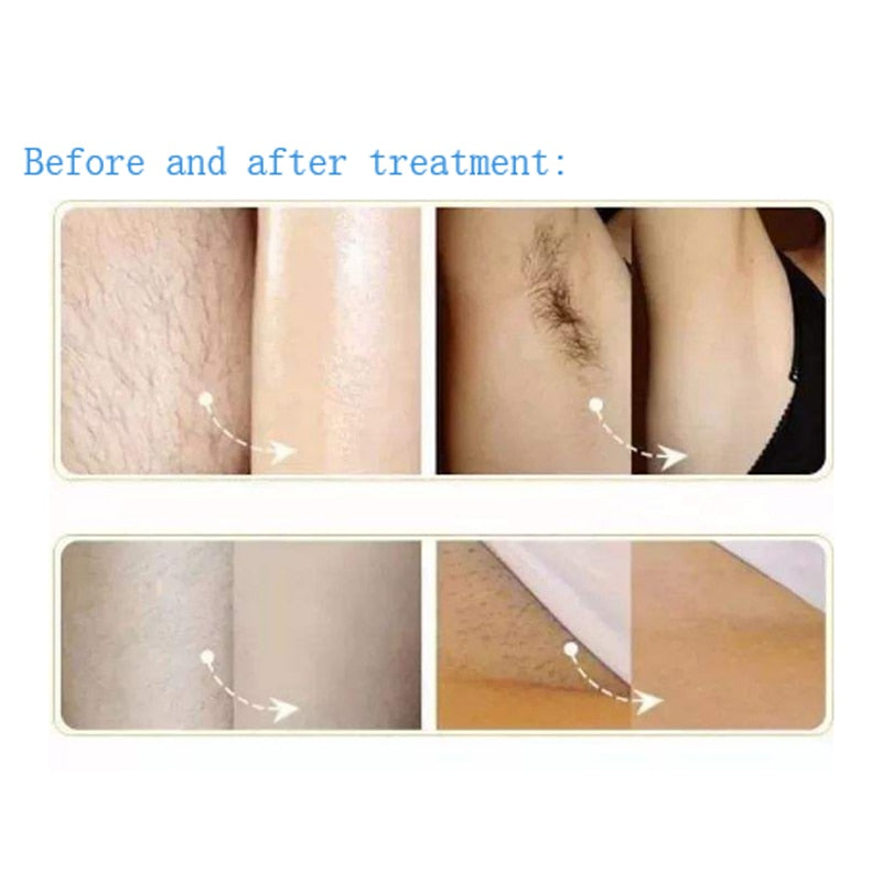 shr hair removal before and after
