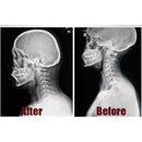 벨벳 목 견인 장치 의료 팽창 식 칼라 자궁 경부 척추 견인