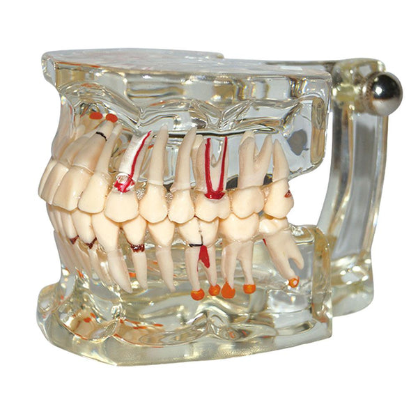 Modelo dental Modelo de patología de dientes con medio implante muestra claramente la forma original y toda la estructura