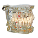 Modelo de patologia de dentes modelo dental com meio implante mostrar claramente a forma original e toda a estrutura