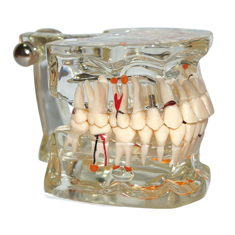 Dental Model Teeth Pathology Model With Half Implant Show Clearly the Original Shape and the Whole Structure