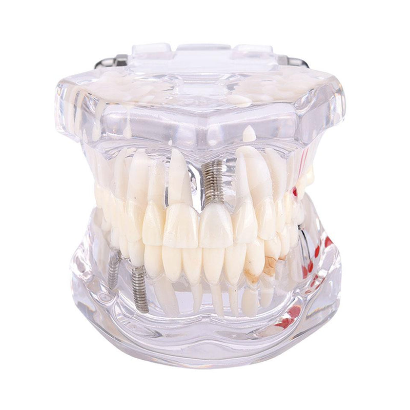 Dental Restoration with Implant Model Showing Some Treatment Methods:Implant, Maryland fixed Bridge, Inlay and Others.