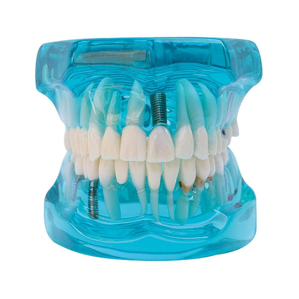 Restauration dentaire avec modèle d'implant montrant quelques méthodes&nbsp;: implant, pont fixe Maryland, incrustation et autres.