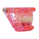 ترميم الأسنان باستخدام نموذج الزرع يوضح بعض الطرق: الزرع، جسر ميريلاند الثابت، التطعيم وغيرها.