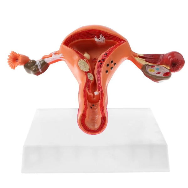 Penyakit ovari dan rahim wanita Model pembedahan Patologi model rahim mengajar manusia alat bantuan perubatan anatomi lesi rahim