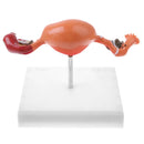 Penyakit ovarium dan rahim wanita Model diseksi Patologi model rahim pengajaran alat bantu medis manusia anatomi lesi rahim