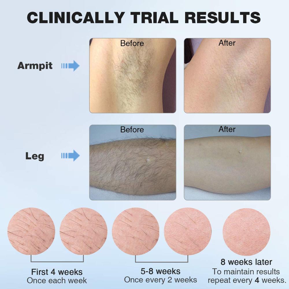 Dispositivo de depilación láser MLAY T4 Depilación IPL en frío ICE