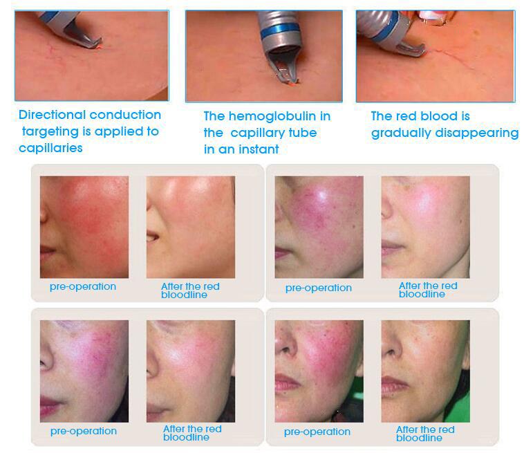 980nm laser diode machine treat facial flushing and remove capillaries